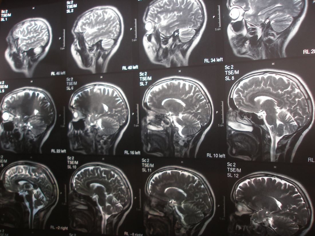 Black and white scans of human brain